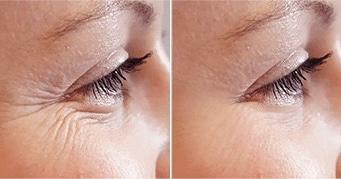 Plasma-Before_After-Eyes-1