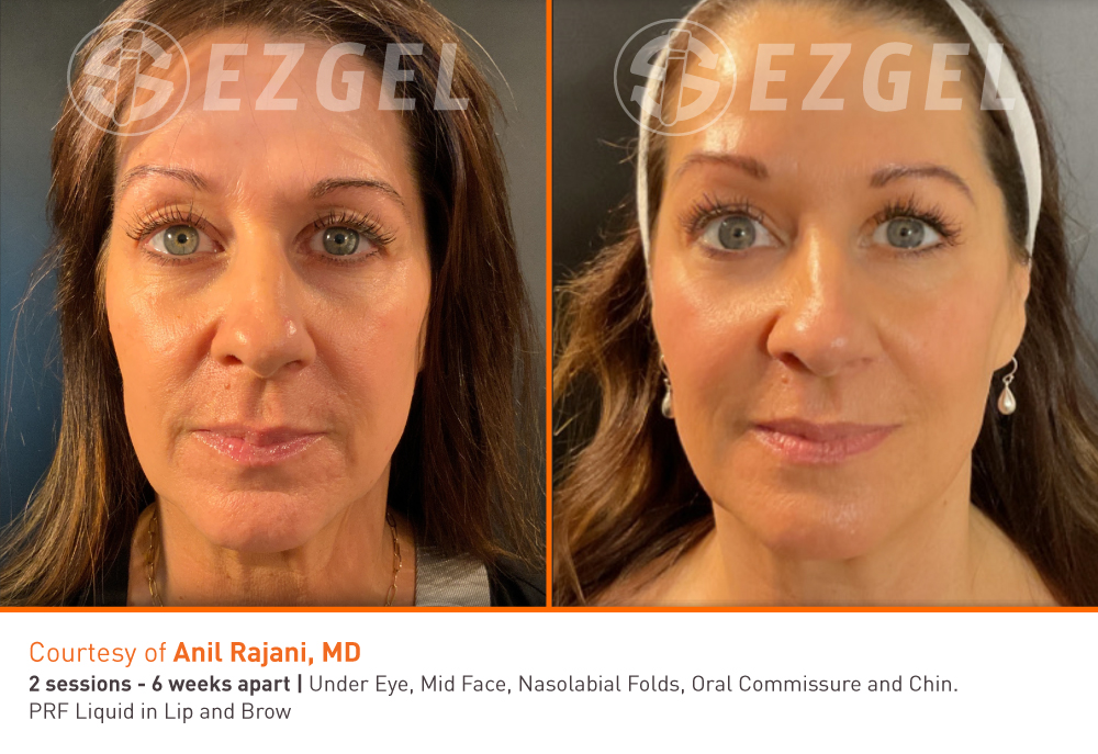 OhZone Clinics EZ Gel Natural Skin Rejuvenation OhZone Clinics EZ Gel Natural Skin Rejuvenation